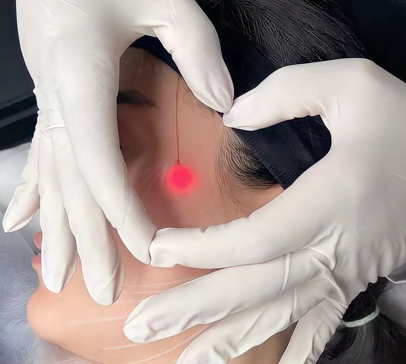 Endolift Facial