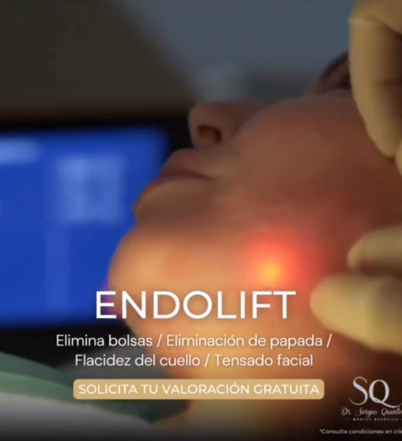Endolift